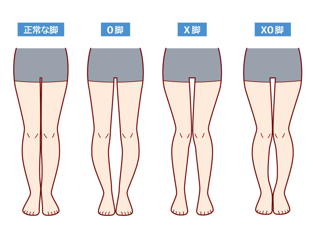 変形性膝関節症の種類